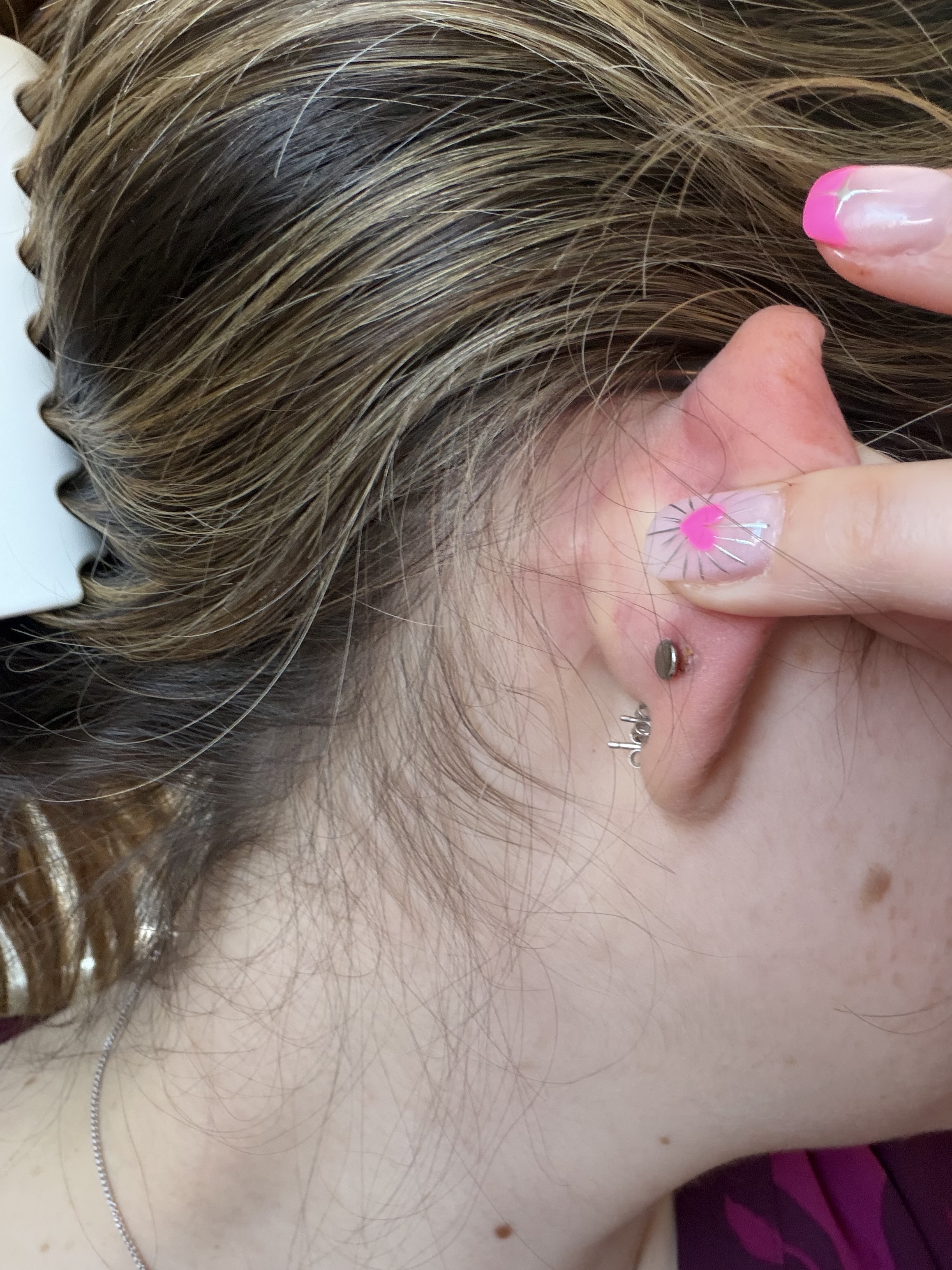 An irritated piercing — caused by pressure and movement, not infection